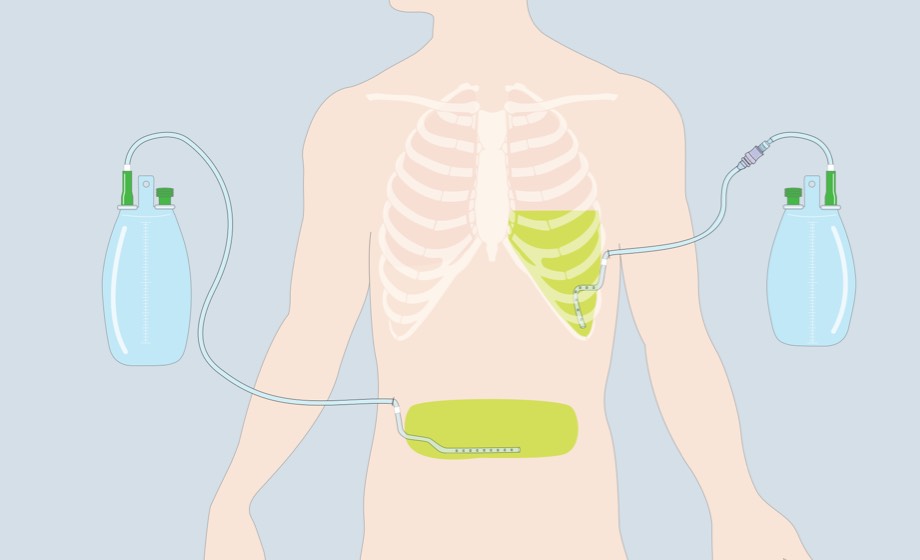 Dauerdrainage bei Pleuraergüssen oder Ascites
